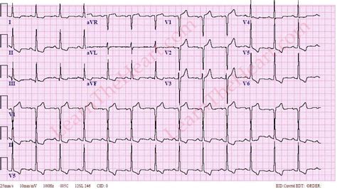 lvh strain pattern.